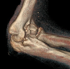 Coronoid Fracture Type 3